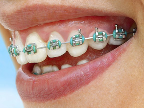 Braces