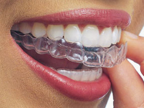 Invisalign