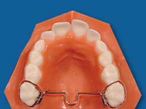 Transpalatal Bar