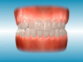 Posterior Crossbite