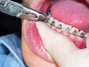 Orthodontic Adjustment