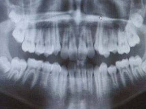 Panoramic X-Ray